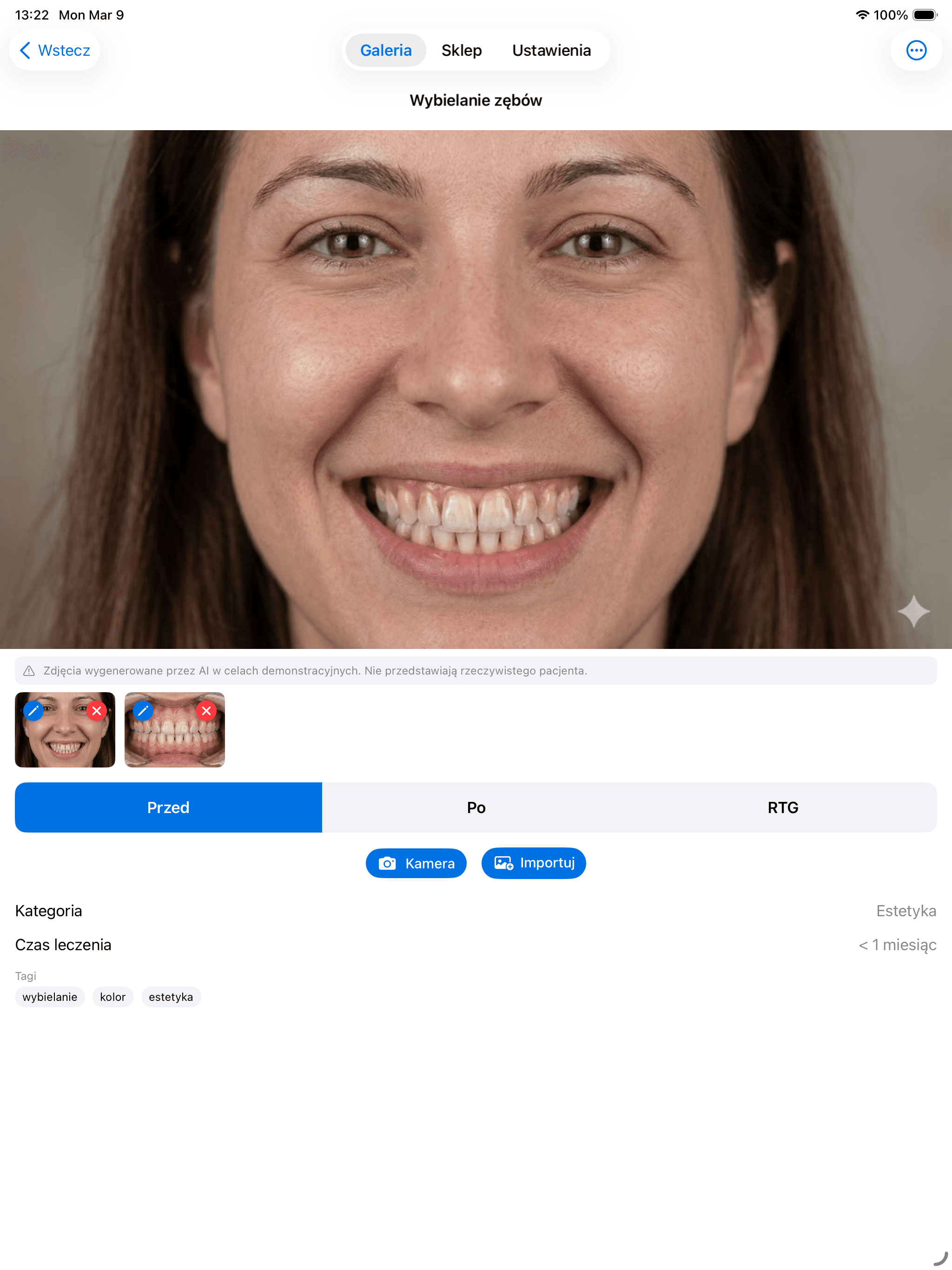 Woman smiling with yellowed teeth in a dental application interface for teeth whitening demonstration.