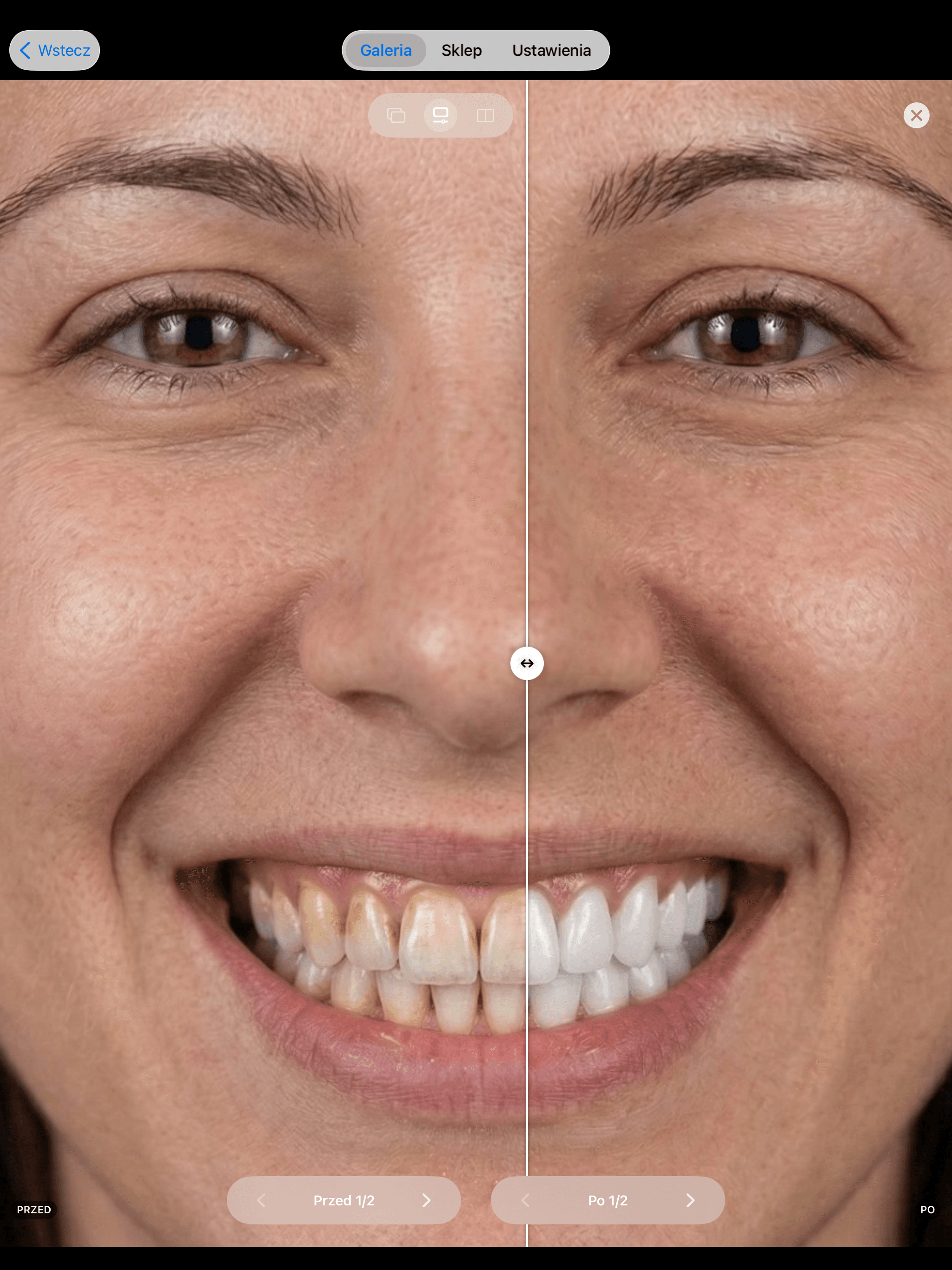 Split-screen view of a woman's smile comparing yellowed, stained teeth with bright, white teeth.